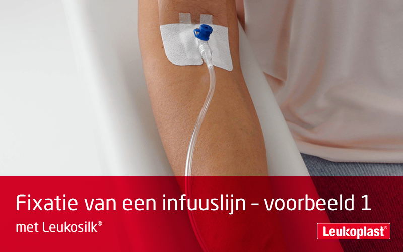 Deze video laat zien hoe een infuuslijn kan worden gefixeerd met een hechtpleister voor de gevoelige huid: de zorgprofessional fixeert deze lijn met Leukosilk op de onderarm van de patient. Deze video laat zien hoe een infuuslijn kan worden gefixeerd met een hechtpleister voor de gevoelige huid: de zorgprofessional fixeert deze lijn met Leukosilk op de onderarm van de patient.
